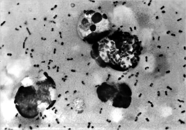 A bubonic plague smear, prepared from a lymph removed from an adenopathic lymph node, or bubo, of a plague patient, demonstrates the presence of the Yersinia pestis bacteria that causes the plague. (c) Getty Images.
