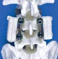 Amplify, a product used in spinal surgery, that act as carriers for bone morphogenetic protein-2 as well as a scaffold for new bone formation.