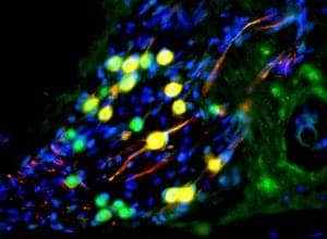 Human stem cell-derived otic neurons repopulating the cochlea of deaf gerbils. Human cells are labelled green, and the red is a marker of neuronal differentiation. Therefore yellow cells are neurons of human origin. (c) University of Sheffield 