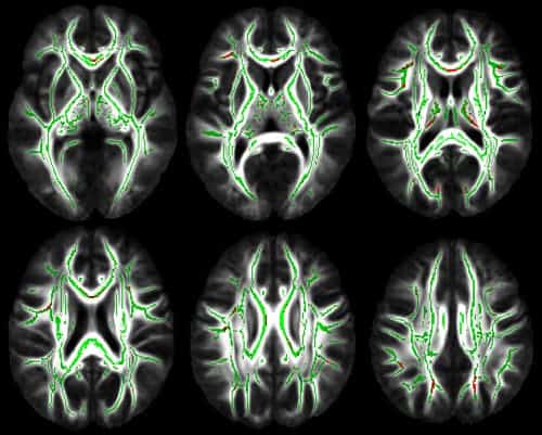 MRI scan brain white matter
