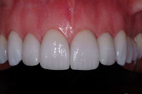 Dental Crown Lengthening