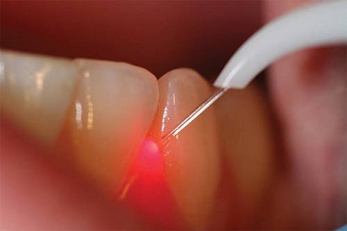 Laser Periodontal Surgery