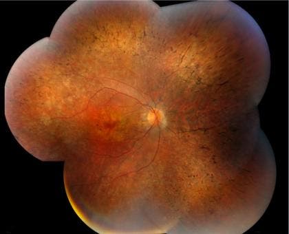 A composite image of the human retina shows diffused pigmentary retinal degeneration. Photo credit – Ziqiang Guan, Duke University Medical Center
