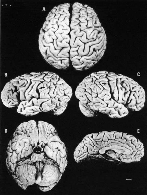 Einstein's brain, photographed in 1955, is about 15% wider than that of most people and, rather than being egg-shaped, it's almost perfectly round. 