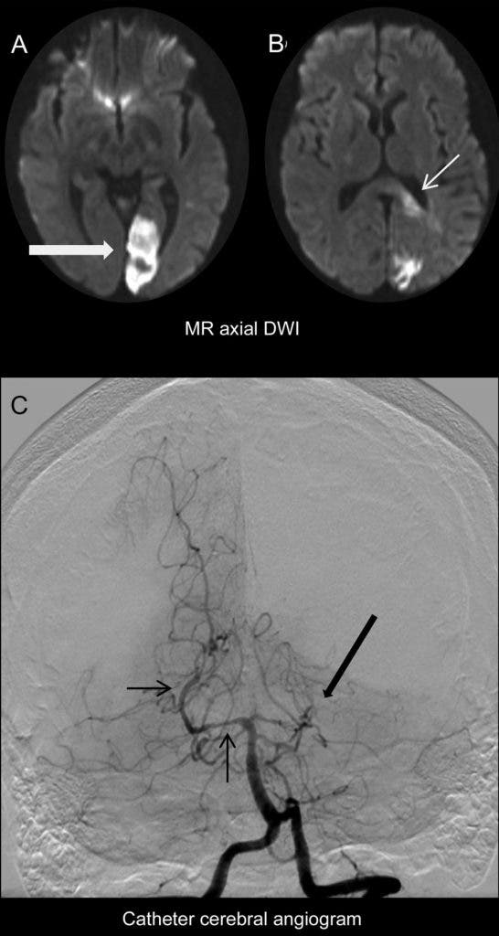 (A, B) Echoplanar axial diffusion-weighted MRI (DWI) shows left posterior cerebral artery territory diffusion restriction including the left visual cortex (large arrow) and the splenium of the corpus callosum (small arrow). (C) Catheter angiogram, left vertebral artery injection, anterior posterior projection shows occlusion of the left posterior cerebral artery (large arrow) and constrictions and dilations of the right posterior cerebral artery consistent with probable primary angiitis of the CNS. (c) Neurology