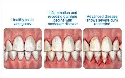 What Is Gum Disease And How Do You Treat It?