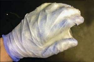 A solution of PLGA nanofibers sprayed from an airbrush forms a mat that conforms to the shape of a surface, such as a gloved hand.
Credit: ACS Macro Lett.
