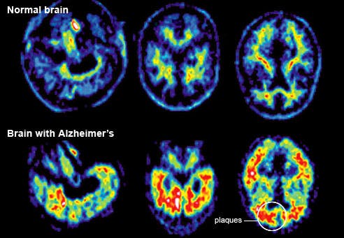 alzheimer brain scan