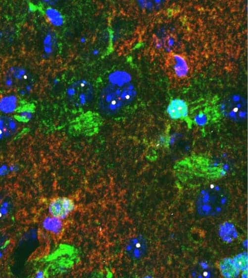 Brain tissue from a mouse shows star-shaped astrocytes (green). Cells (blue) containing mutant protein (white) display lower levels of a potassium-regulating protein (red). Photo: UCLA