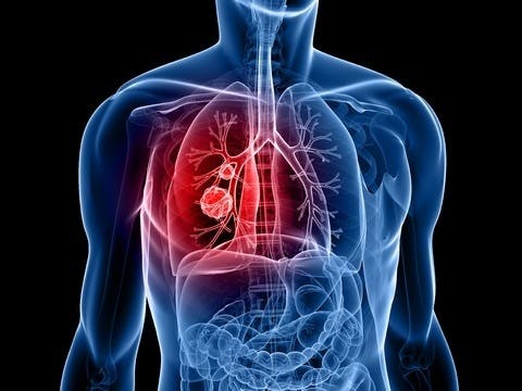 lung_cancer