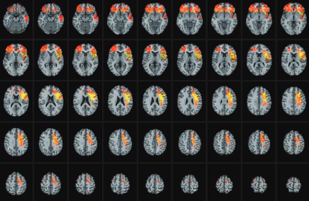 Brain mapping of leisure suffering subjects. Image; Aron K. Barbey et al./BRAIN
