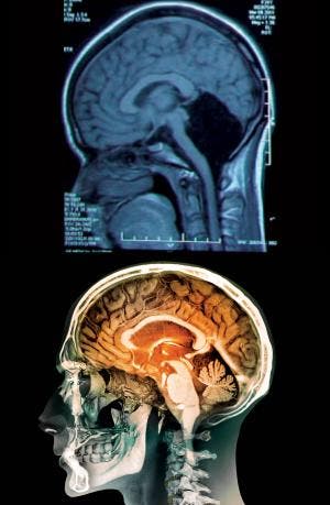 A hole at the back (top) where the cerebellum should be (Top image: Feng Yu et al.; Bottom image: Zephyr/Science Photo Library )