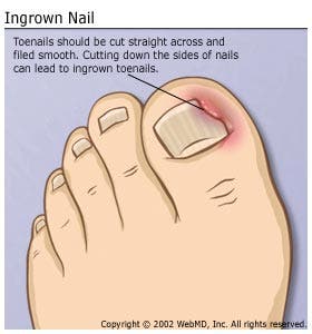 Why some people have ingrown toenails, explained by science