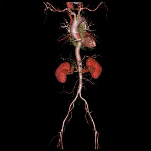The whole aorta and kidneys.