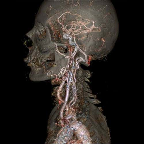 The skull and carotid arteries.