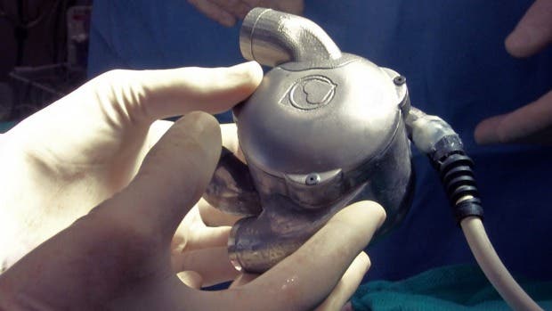 A bionic heart could save millions of lives every year. Image credits: Prince Charles Hospital.