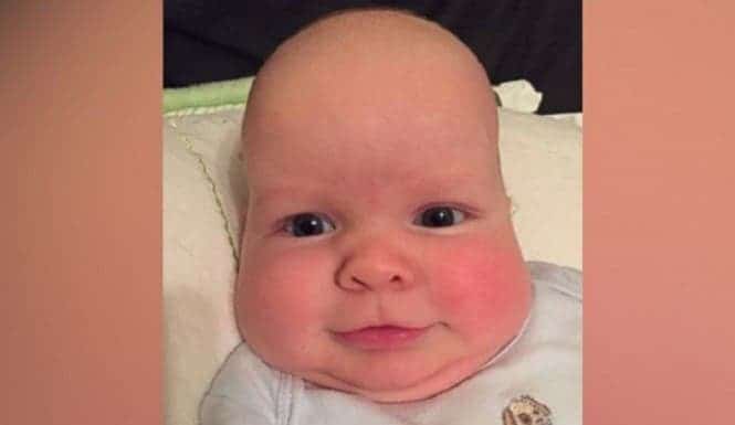This baby was born with a rare condition that deformed his ...