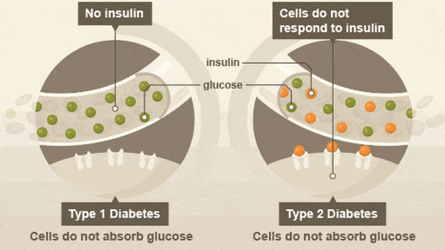 Main differences between Type I and Type II diabetes. Image: BBC