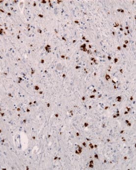 Buildup in brain cells of the protein alpha-synuclein (dark spots) occurs in the neurodegenerative disorder Multiple System Atrophy (MSA).

Jensflorian/Wikimedia Commons, CC BY-SA 3.0