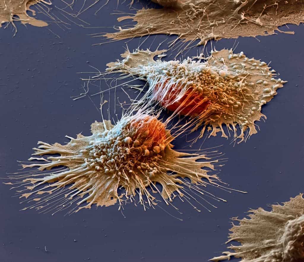 Cancer cells viewed under an electron microscope.
Image via imgur