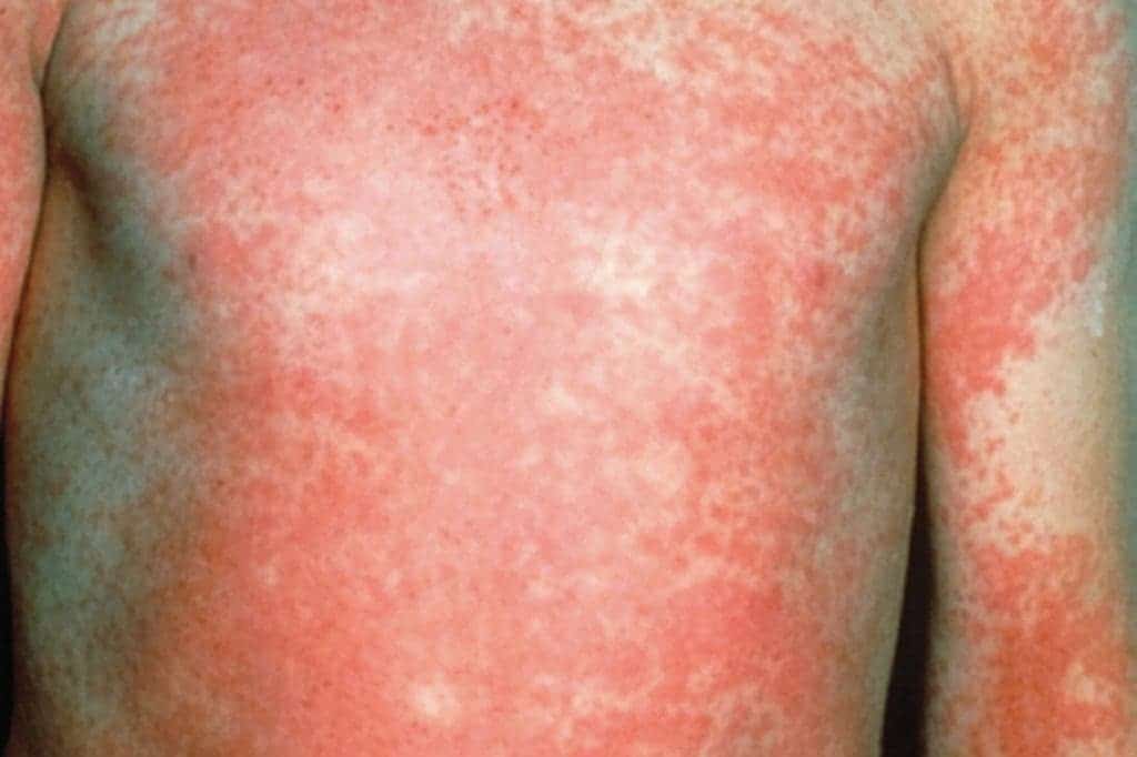 A scarlet fever rash.
Image via newsshopper