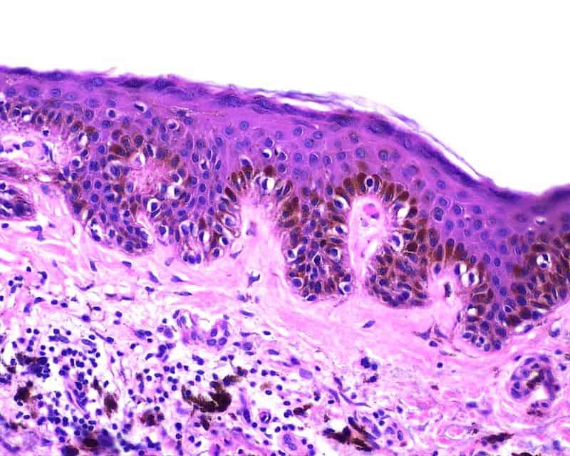Melanocytic nevus tissue.
Image via wikipedia