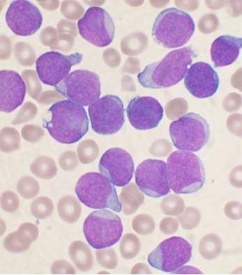 A Wright's stained bone marrow aspirate smear of patient with precursor B-cell acute lymphoblastic leukemia. Photo by  VashiDonsk
