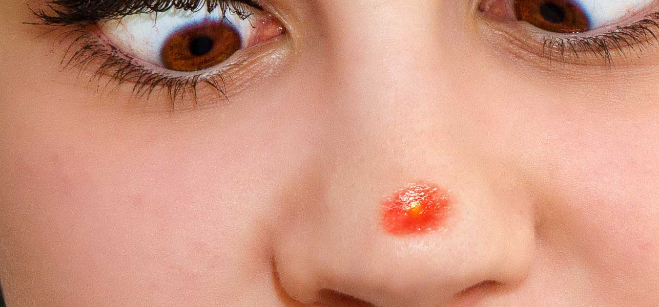 Why you shouldn't pop your pimples -- Really, you shouldn't