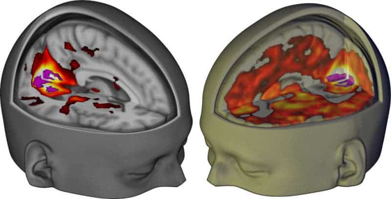 Left: brain scan of adult brain under a placebo showing primary visual cortex connections. Right: the same connection under the influence of LSD where multiple brain areas are involved. Credit: Imperial College London