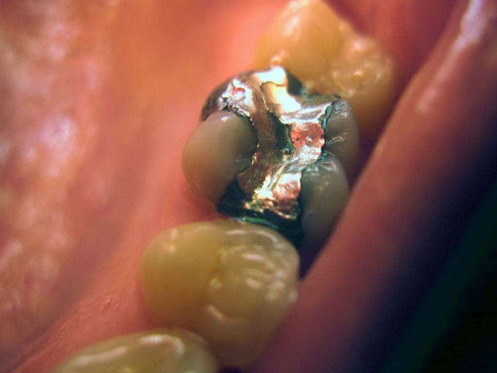 Amalgam filling on first molar. Credit: Wikimedia Commons