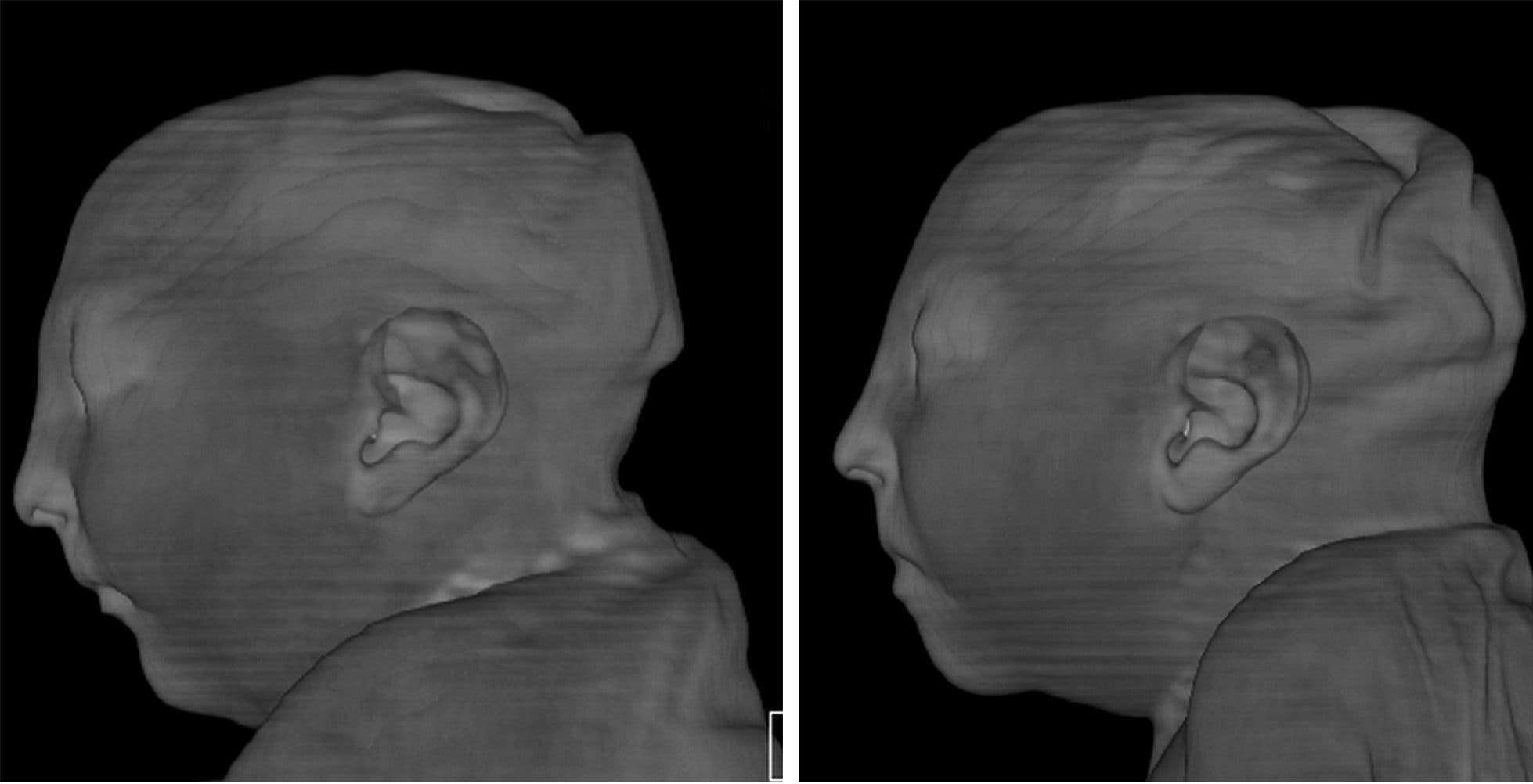 The heads of two twin girls whose mother was infected with Zika during pregnancy. Credit: Radiology