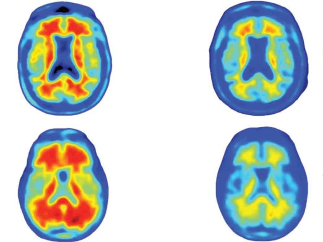 Brainscans of Alzheimer's patients, showing how different doses of the drug reduced the number of amyloid plaques, in red, over a year.
Image credits Sevigny et al.