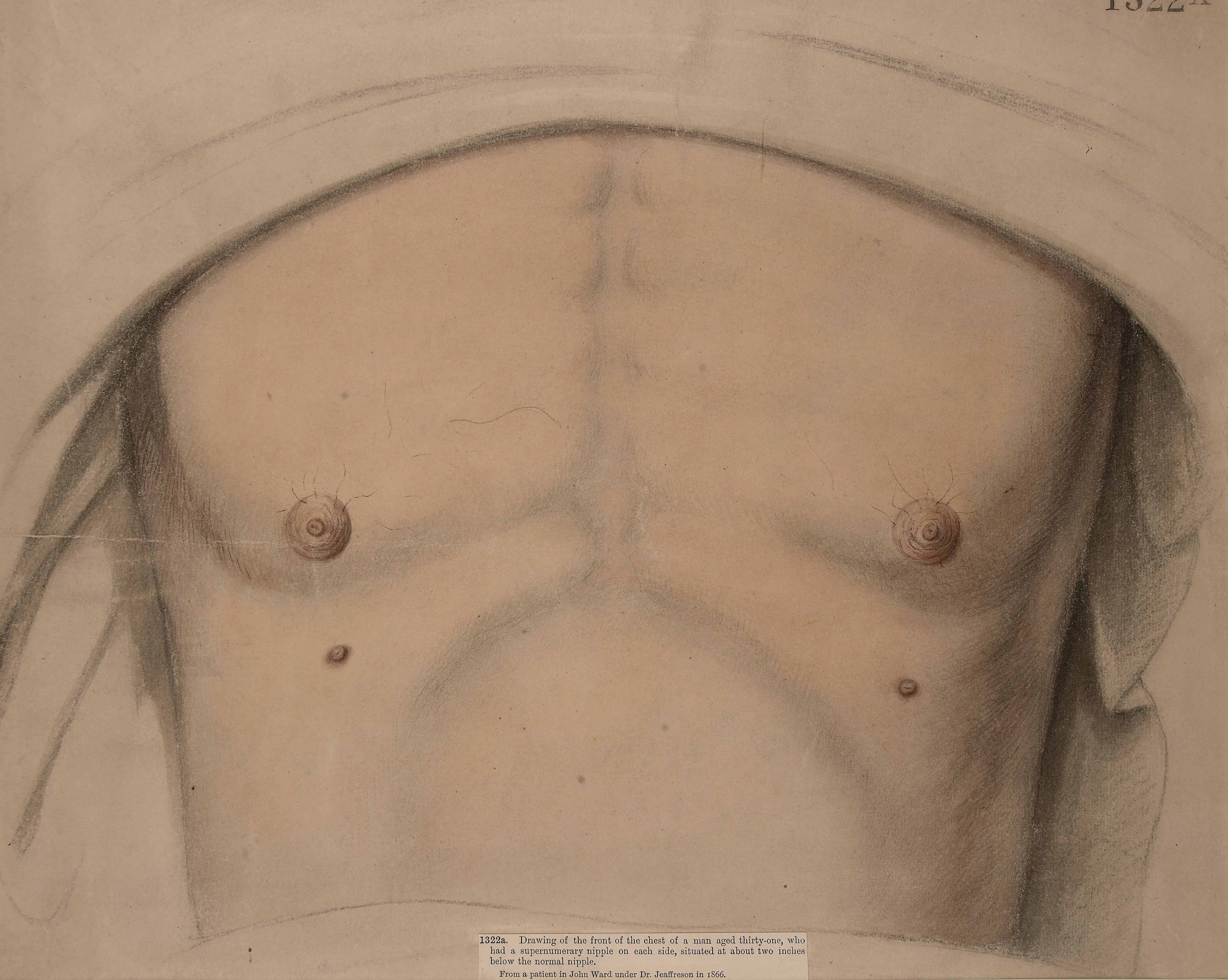 A man with extra nipples. Image credits: Thomas Godard.