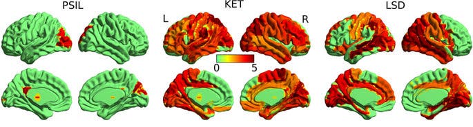 Brain activity with (left to right) psilocybin, ketamine and LSD. The red areas indicate higher levels of random brain activity than normal. Image credits: Suresh Muthukumaraswamy.