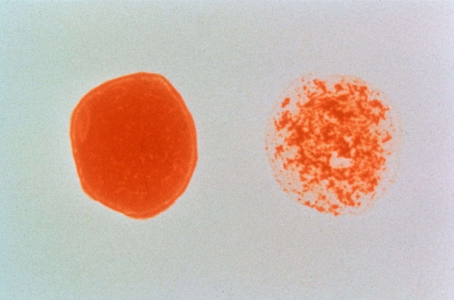 HIV positive blood cell vs HIV negative blood cell:  'clumping' indicates a positive result. Image via Wikipedia / CSIRO.