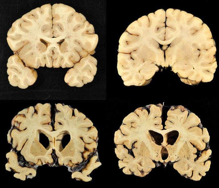 Top: normal healthy brain. Bottom: the brain of Greg Ploetz who played   defensive tackle for the Texas Longhorns and who suffered from severe chronic traumatic encephalopathy. Credit: Boston University Photography.