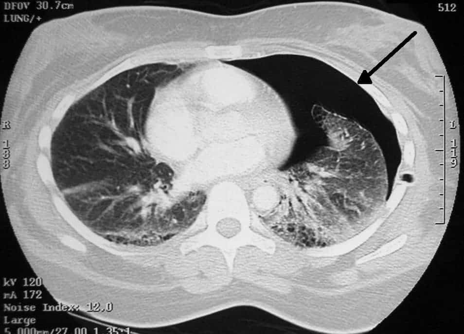 Right-sided pneumothorax (right side of image) on CT scan of the chest. Image via Clinical Cases / Wikipedia.