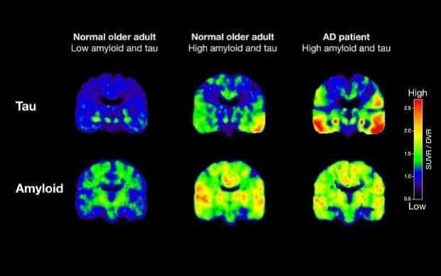 Brain scans showing the differing distribution of amyloid plaques and tau tangles in patients with Alzheimer's disease. Credit: University of California. 
