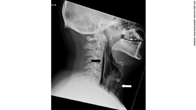 Lateral soft tissue neck radiograph showing streaks of air in the retropharyngeal region (black arrow) and extensive surgical emphysema in the neck anterior to the trachea (white arrow).