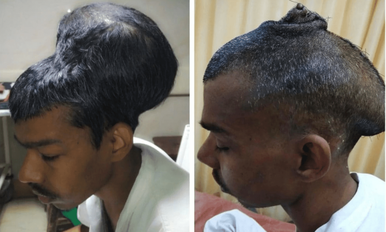 Santlal Pal before and after he had his huge tumor removed. Credit: Nair Hospital.