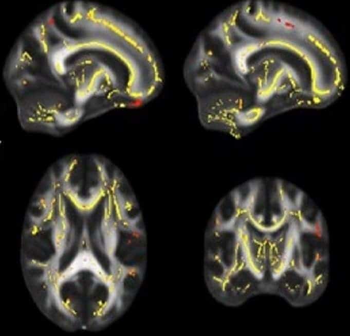 Brain imaging shows yellow and reddish pixels representing areas where the functionality of white matter is associated with higher fitness levels. The images are based on cumulative data from patients in a study showing potential links between physical fitness and deterioration of white matter. Image credits: UT Southwestern.