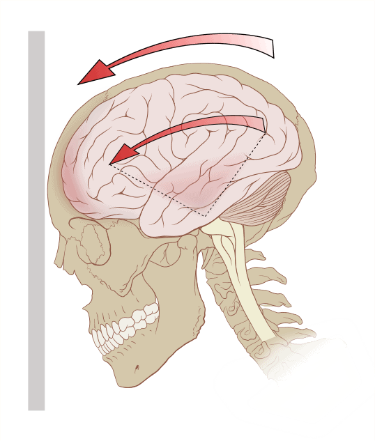 The forces acting on the brain in the event of a concussion. Image credits: Patrick J. Lynch.