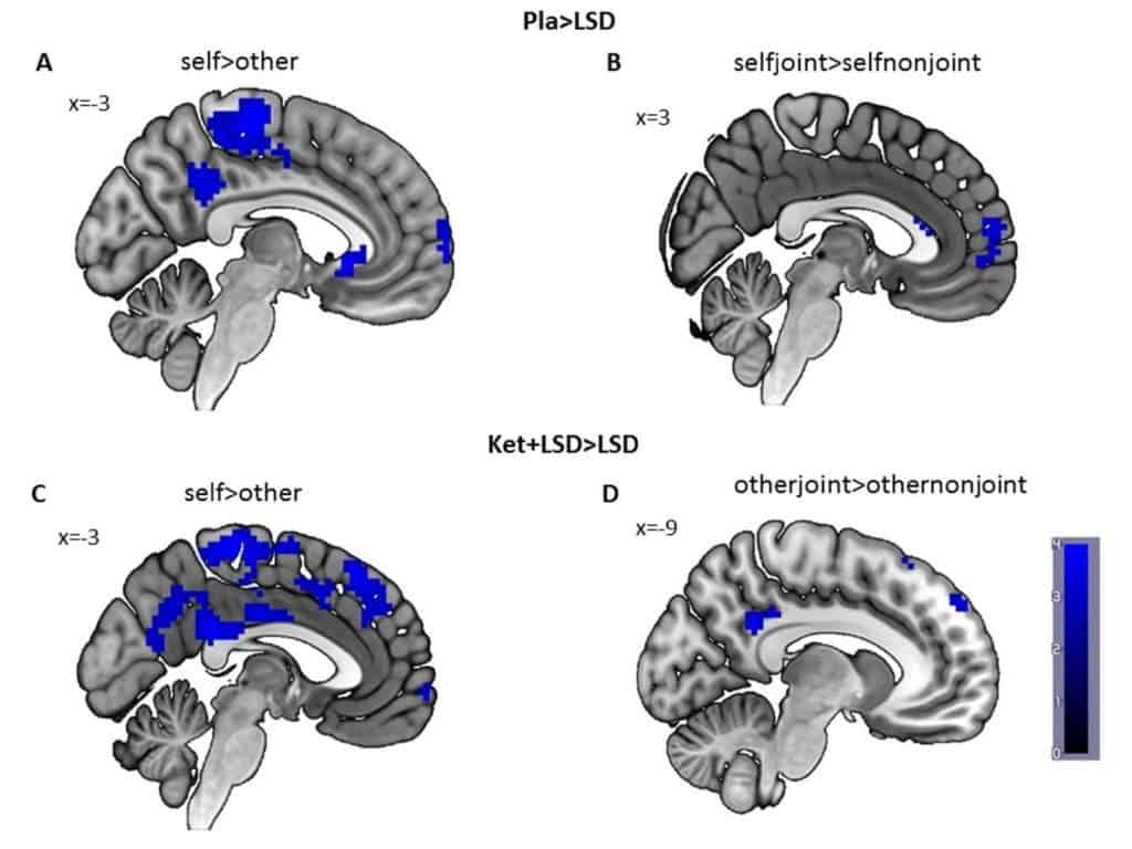 LSD reduced activity in the posterior cingulate cortex and the temporal cortex, brain areas important for establishing one's sense of self. Credit: JNeurosci.