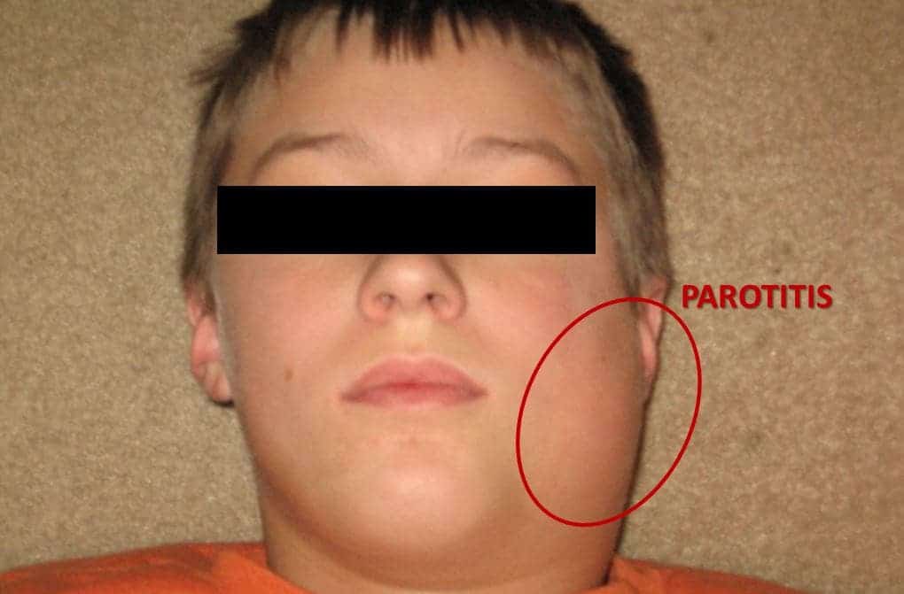 Parotitis is the inflammation and swelling of the salivary glands.