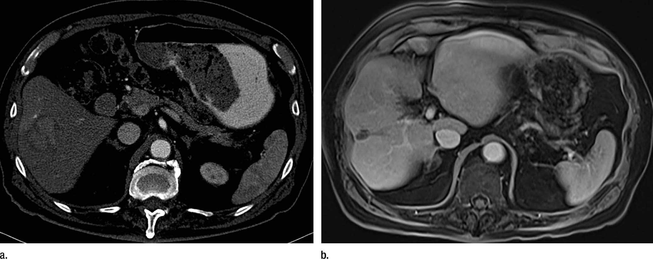 Images show (a) contrast material-enhanced CT scan before yttrium 90 of an 87-year-old man with 4-cm hepatocellular carcinoma in right lobe. (b) Contrast-enhanced MR image at subsequent 9-year follow-up (now aged 96 years) shows complete necrosis.