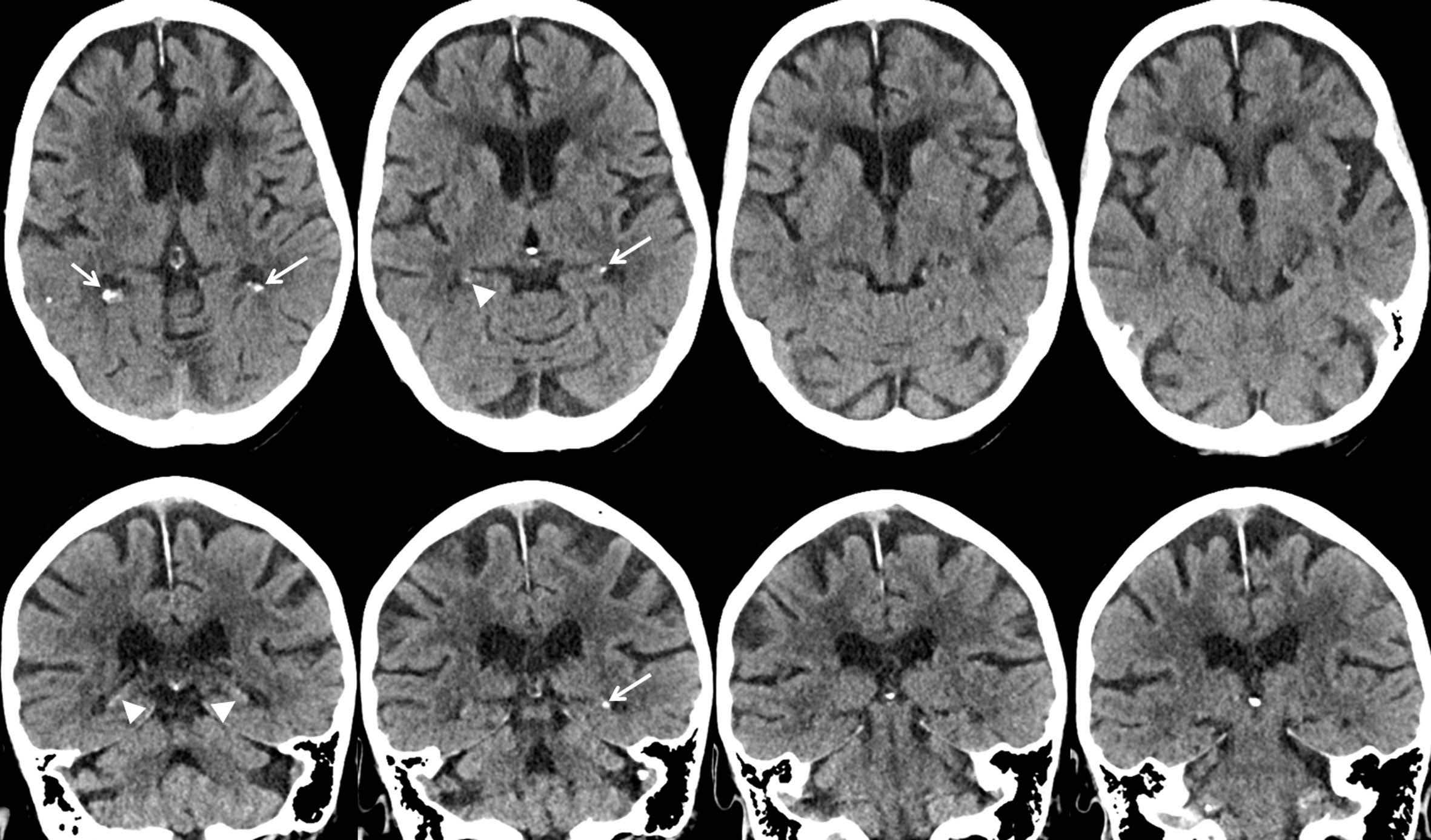 Axial and coronal CT images in 88-year-old woman show mild hippocampal calcification (arrowheads). Image credits: Radiological Society of North America.