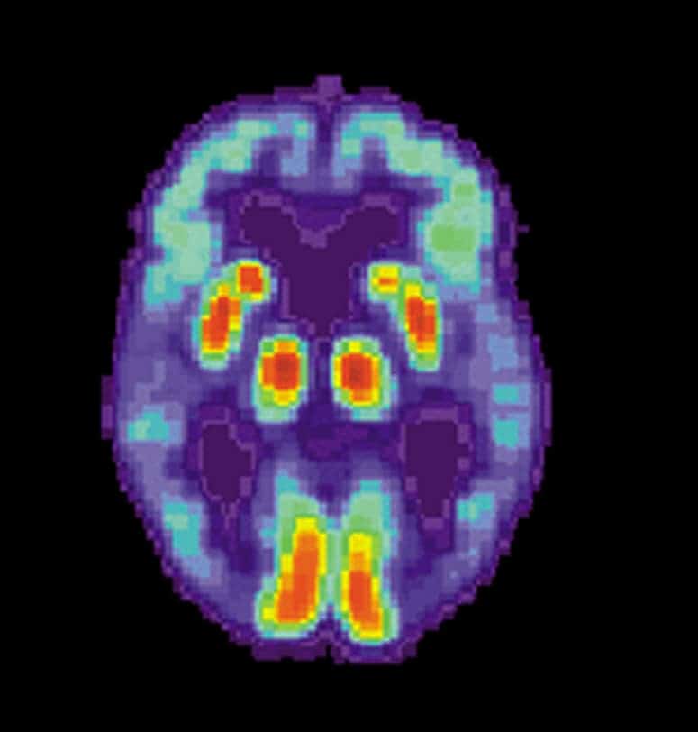 PET scan of a human brain with Alzheimer's disease.