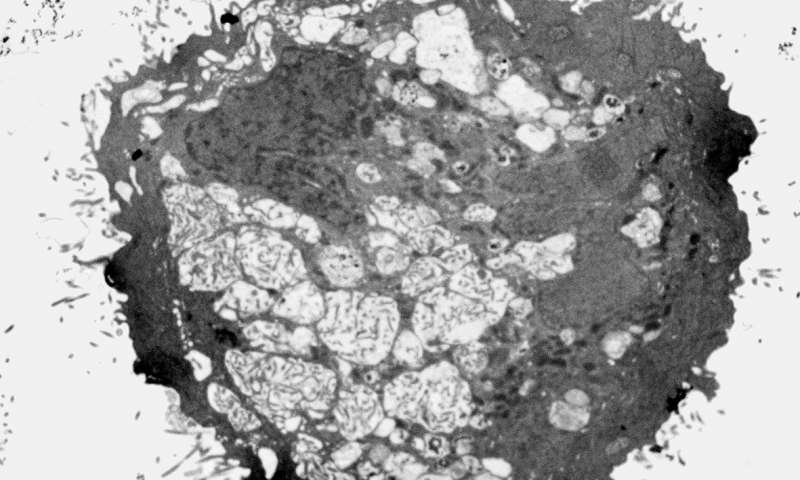 Self-destructing brain tumor cell captured by electron microscopy after treatment with the small molecule KHS101. Credit: Stem Cells and Brain Tumour Group, University of Leeds