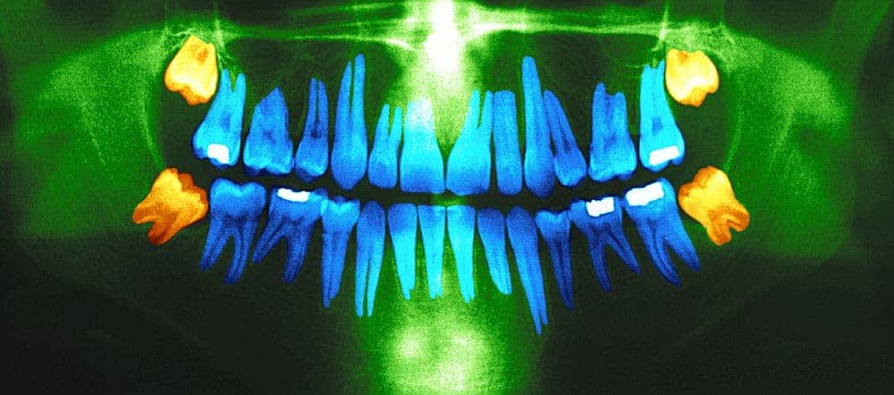 Dental panoramic x-ray. In orange,the wisdom teeth. Image courtesy: IHPI.