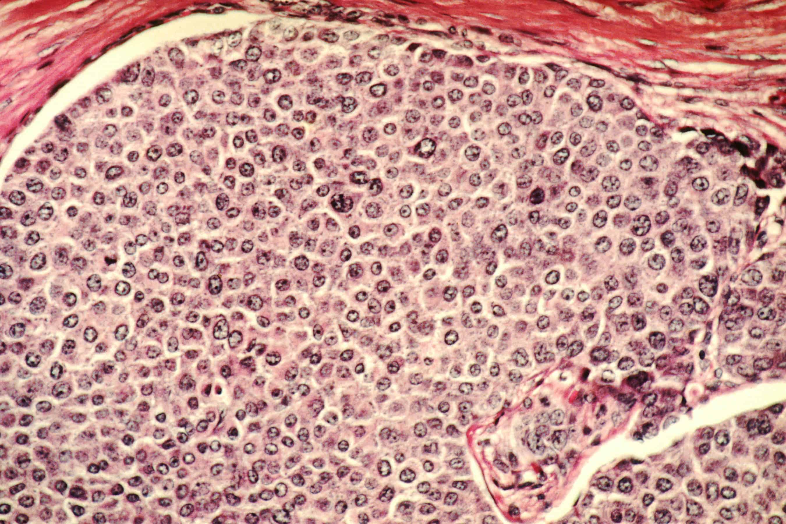 Breast cancer cells. Credit: Wikimedia Commons.